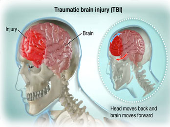 Traumatic Brain Injury (TBI) treatment